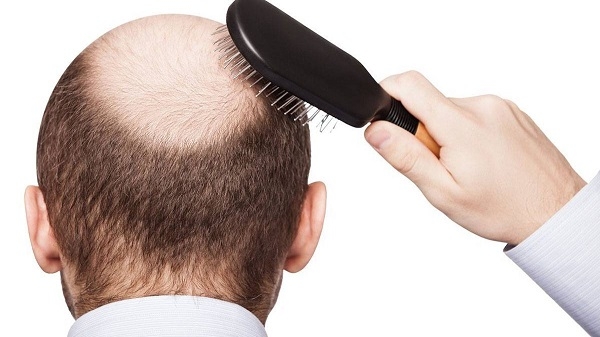 عناصر أساسية تسهم في فقدان الشعر