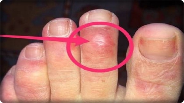 أصابع كوفيد، أحدث أعراض الإصابة بفيروس كورونا