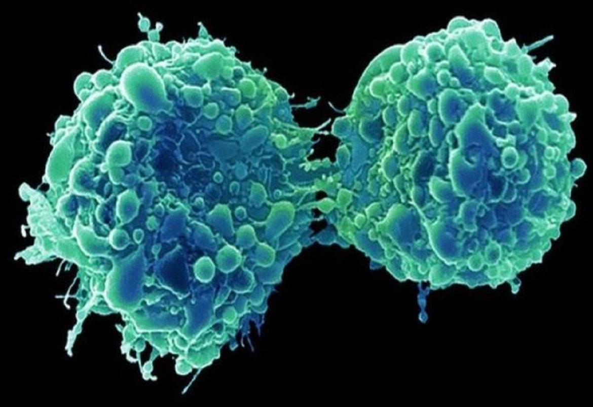 سرطان المثانة: فيروس زكام شائع "يقتل الخلايا الخبيثة ويمنع عودتها"