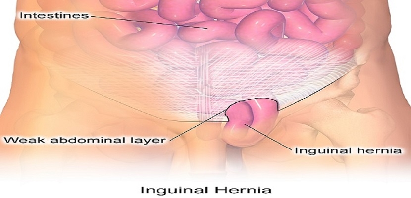 "الفتق الإربي" Inguinal hernia ، وأسبابه، وأعراضه